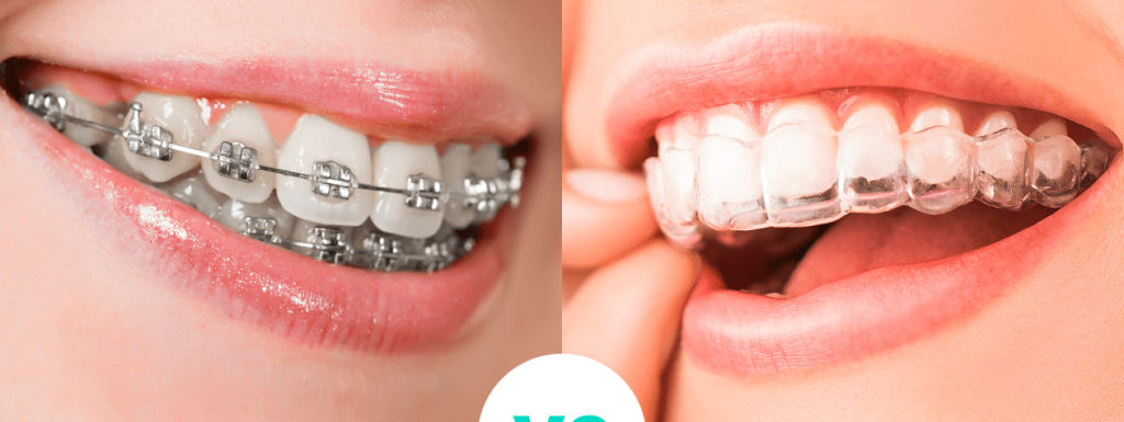 ? Alineadores Vs Brackets, ¿cuál Escoger?