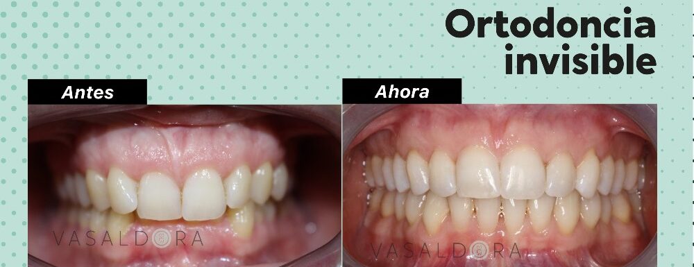 ¿braquets Ahora Invisalign?