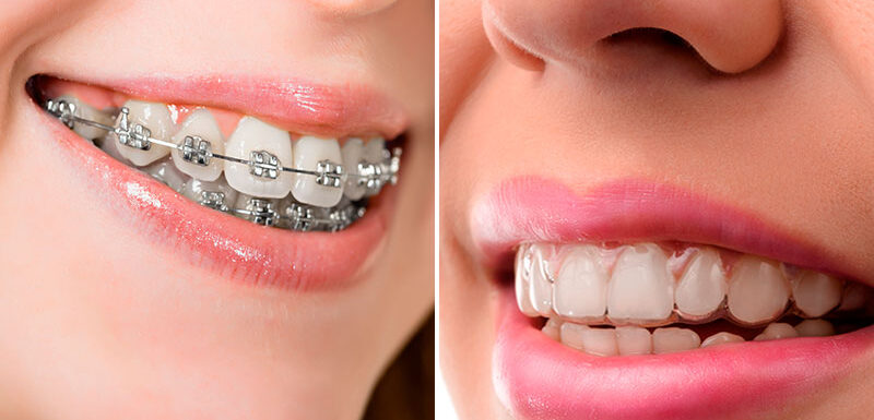 Ortodoncia Tradicional Vs Ortodoncia Intocable