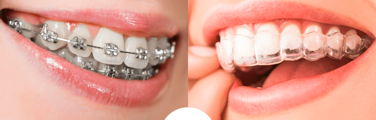 Preeminencias De La Ortodoncia Invisible Frente A Los Brackets