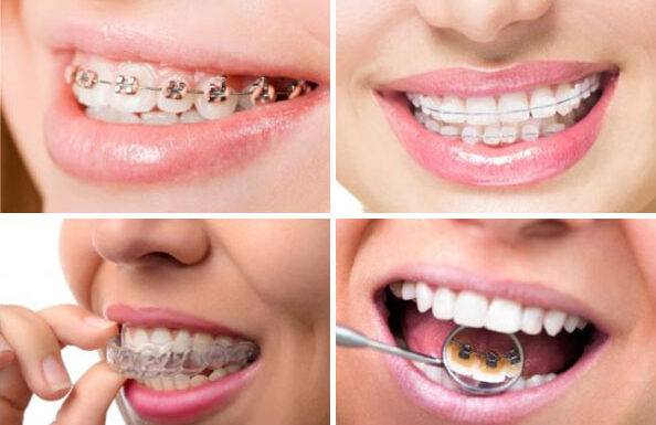 Qué Elegir: ¿brackets, Alineadores Transparentes U Ortodoncia Lingual? Ortodoncia Logroño Y Vitoria