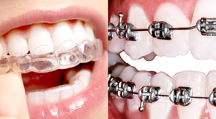 Incompatibilidades Entre Brackets También Ortodoncia Invisible