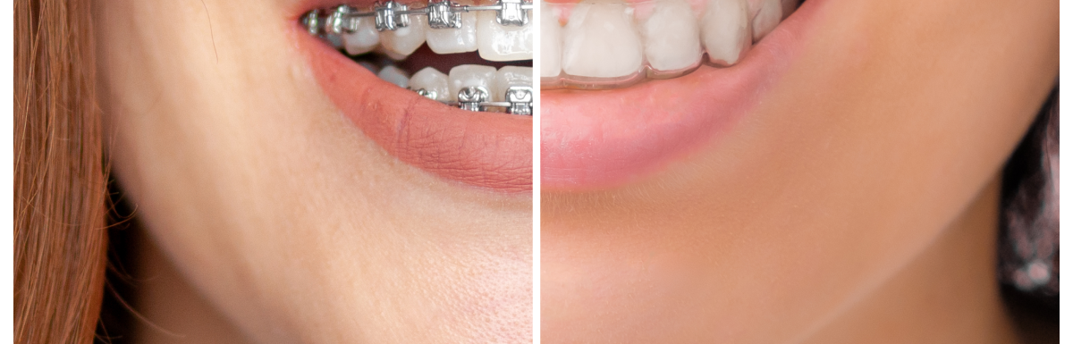 ¿ortodoncia Con Brackets U Ortodoncia Invisible? Vos Clínica Dental Madrid