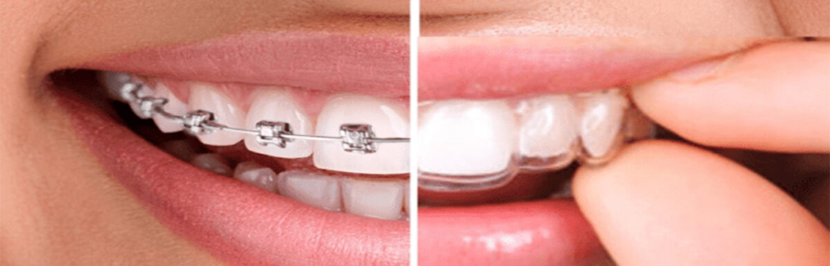 Ortodoncia Invisible O Brackets