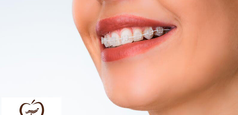 Ortodoncia Invisible O Brackets ¿cuál Es Genial En 2022?