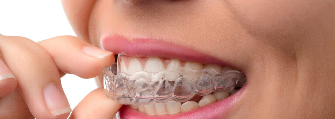 Ortodoncias Y Brackets Invisibles En Madrid