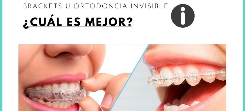 Preeminencias De La Ortodoncia Invisible Frente Con Los Brackets