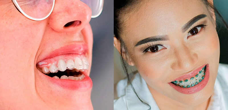 ? Alineadores Vs Brackets, ¿cuál Escoger?