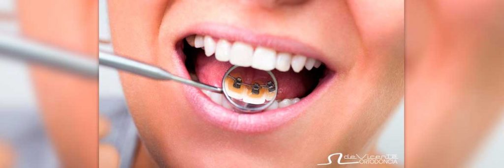 El Ortodoncia Lingual, El Otra Ortodoncia Intocable