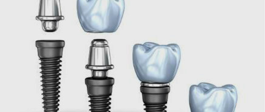 Implantes Dentales: Tipos Y Encasillamiento