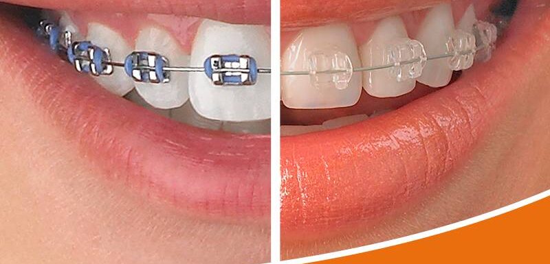 Ortodoncia Afectado Vs Ortodoncia Impalpable