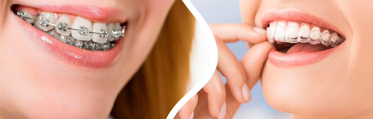 Ortodoncia Invisible O Brackets ¿cuál Es Genial En 2022?