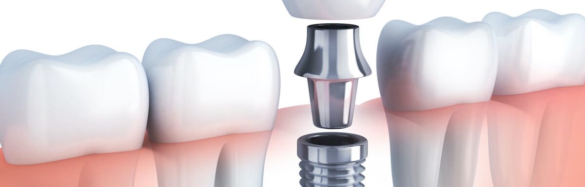 ¿que Son Los Implantes Dentales?
