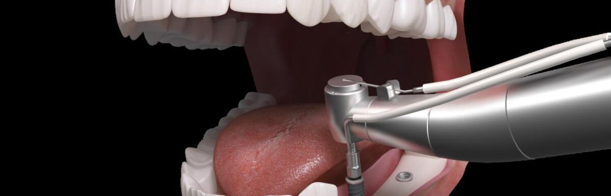 ¿qué Son Los Implantes Dentales? Todo Sobre Los Implantes Dentales