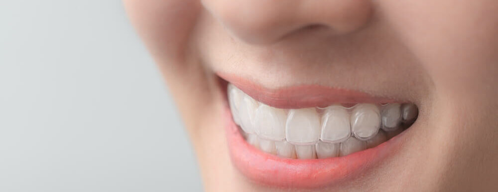 Tipos De Ortodoncia Invisible, Cómo Ordenar Los Dientes Fuera De Que Rápidamente Se Note