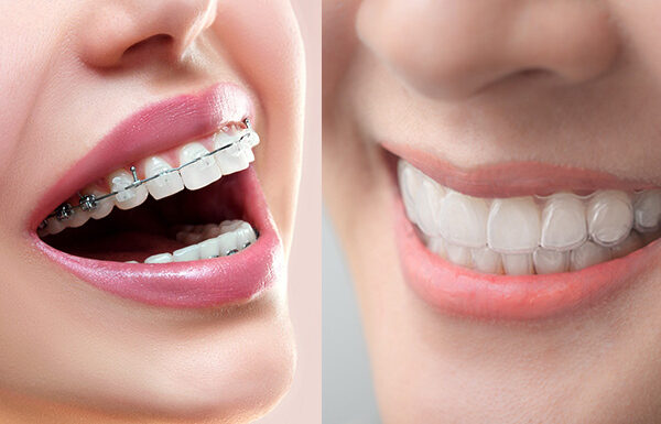 Diferencia Entre Ortodoncia Invisible Y Brackets