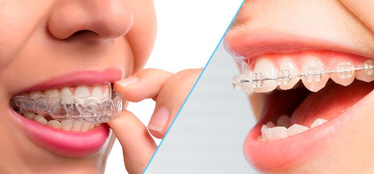 ¿invisalign O Brackets? ¿qué Ortodoncia Entrega Mejores Resultados?