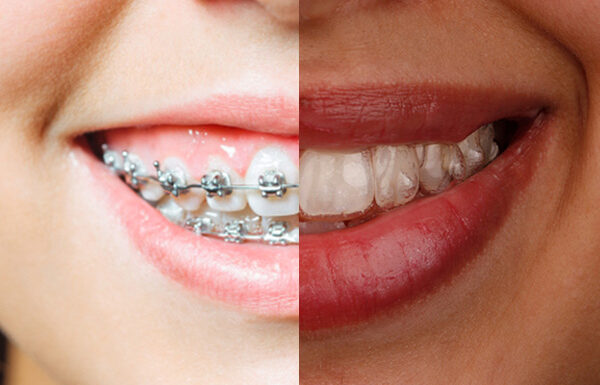 Ortodoncia Convencional Vs Ortodoncia Impalpable