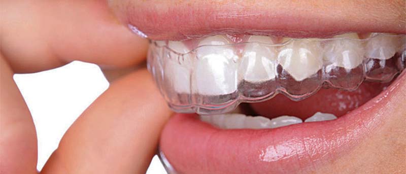 Ortodoncia Invisible, El Ortodoncia Sin Brackets